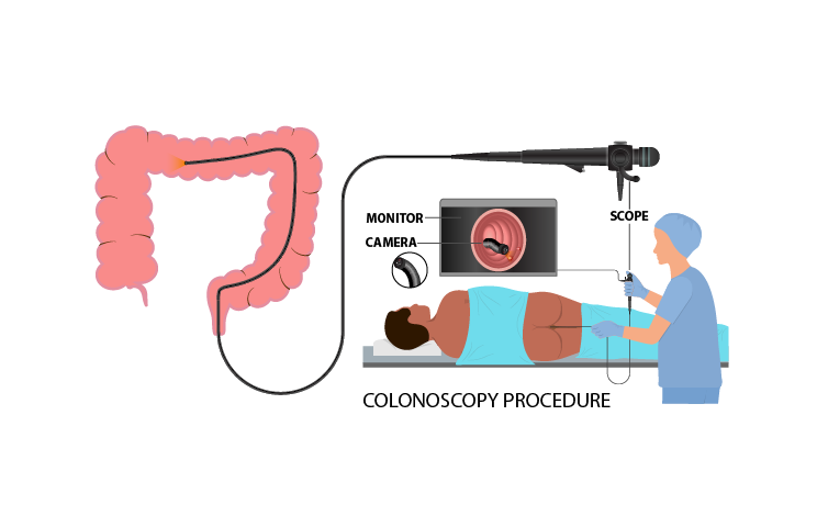 Colonoscopy View